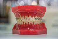 Ortodoncja a higiena jamy ustnej
